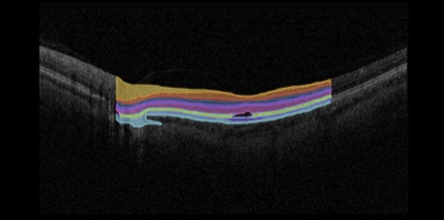 OCT Macula